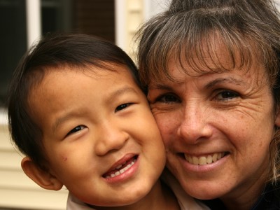 Image of a child who had cleft lip repair surgery