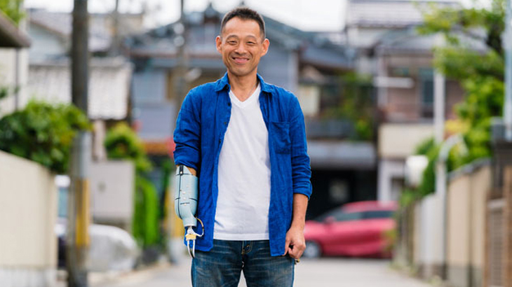 Smiling man with amputated arm.